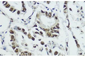 Immunohistochemistry of paraffin-embedded Human lung cancer using Phospho-Histone H3(T11) Polyclonal Antibody at dilution of 1:100 (40x lens).