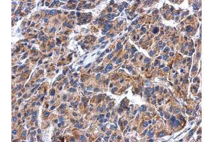 IHC-P Image Immunohistochemical analysis of paraffin-embedded human hepatoma, using GBA, antibody at 1:500 dilution. (GBA Antikörper  (Center))