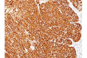 Formalin-fixed, paraffin-embedded human Melanoma stained with Melanoma Marker Monoclonal Antibody (M2-7C10 + M2-9E3 + T311 + HMB45). (Melanoma Marker (MART-1 + Tyrosinase + Gp100) Antikörper)