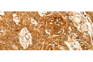 Immunohistochemistry of paraffin-embedded Human esophagus cancer tissue using VSNL1 Polyclonal Antibody at dilution of 1:25(x200) (VSNL1 Antikörper)