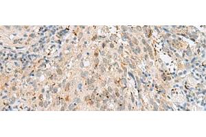 Immunohistochemistry of paraffin-embedded Human cervical cancer tissue using GTF3C2 Polyclonal Antibody at dilution of 1:45(x200) (GTF3C2 Antikörper)