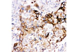 Anti- HMOX2 antibody, IHC(P) IHC(P): Human Lung Cancer Tissue