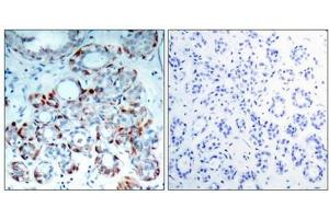 Immunohistochemical analysis of paraffin-embedded human breast carcinoma tissue using BIM(Phospho-Ser69) Antibody(left) or the same antibody preincubated with blocking peptide(right). (BIM Antikörper  (pSer69))