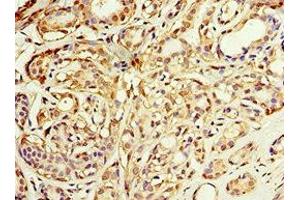 Immunohistochemistry of paraffin-embedded human breast cancer using ABIN7143649 at dilution of 1:100 (ADH1C Antikörper  (AA 1-375))