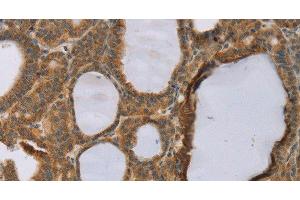 Immunohistochemistry of paraffin-embedded Human thyroid cancer using RNF5 Polyclonal Antibody at dilution of 1:35 (RNF5 Antikörper)