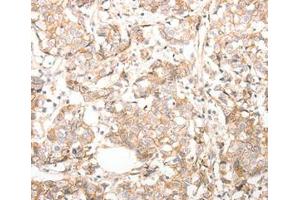 Immunohistochemical analysis of paraffin-embedded Human breast cancer tissue using at dilution 1/30. (CDH23 Antikörper  (C-Term))
