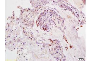 Formalin-fixed and paraffin embedded human colon carcinoma labeled with Anti-SDHD Polyclonal Antibody, Unconjugated (ABIN751918) at 1:200, followed by conjugation to the secondary antibody and DAB staining