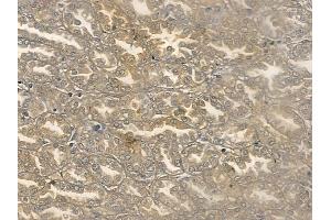 ABIN6260085 and ABIN6269286 at 1/100 staining human renal cell carcinoma by IHC-P. (Ataxin 1 Antikörper  (C-Term))