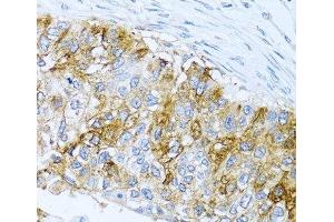 Immunohistochemistry of paraffin-embedded Human lung cancer using IFIT3 Polyclonal Antibody at dilution of 1:100 (40x lens). (IFIT3 Antikörper)