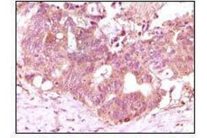 Immunohistochemical analysis of paraffin-embedded human recturn adenocarcinoma tissue showing cytoplasmic localization using FGF2 mouse mAb with DAB staining. (FGF2 Antikörper)