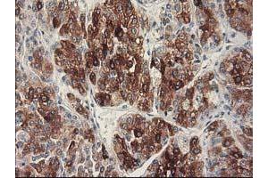 Immunohistochemical staining of paraffin-embedded Carcinoma of Human liver tissue using anti-CYP2C9 mouse monoclonal antibody. (CYP2C9 Antikörper)