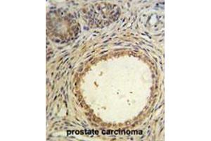AMH Antibody (Center) IHC analysis in formalin fixed and paraffin embedded prostate carcinoma followed by peroxidase conjugation of the secondary antibody and DAB staining.