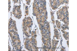 Immunohistochemistry of Human breast cancer using IPO7 Polyclonal Antibody at dilution of 1:40 (IPO7 Antikörper)