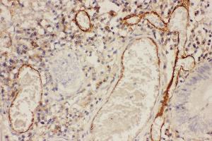 Anti-ICAM1 Picoband antibody,  IHC(P): Human Intestinal Cancer Tissue (ICAM1 Antikörper  (AA 214-532))