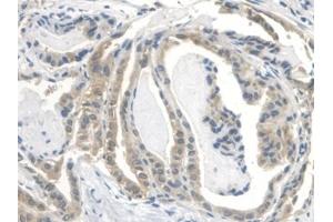 Detection of IGFBP2 in Human Thyroid cancer Tissue using Polyclonal Antibody to Insulin Like Growth Factor Binding Protein 2 (IGFBP2) (IGFBP2 Antikörper  (AA 148-325))