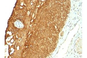 Formalin-fixed, paraffin-embedded human Cervical Carcinoma stained with Cytokeratin 19 Mouse Monoclonal Antibody (KRT19/800). (Cytokeratin 19 Antikörper)