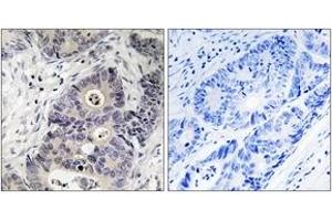 Immunohistochemistry analysis of paraffin-embedded human colon carcinoma, using iNOS (Phospho-Tyr151) Antibody. (NOS2 Antikörper  (pTyr151))