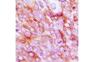 Immunohistochemical analysis of EP2 staining in human prostate cancer formalin fixed paraffin embedded tissue section. (PTGER2 Antikörper  (C-Term))