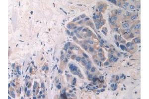 Detection of FBLN1 in Human Breast cancer Tissue using Polyclonal Antibody to Fibulin 1 (FBLN1) (Fibulin 1 Antikörper  (AA 176-398))