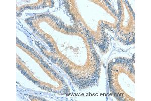 Immunohistochemistry of Human colon cancer using ASGR1 Polyclonal Antibody at dilution of 1:50 (Asialoglycoprotein Receptor 1 Antikörper)