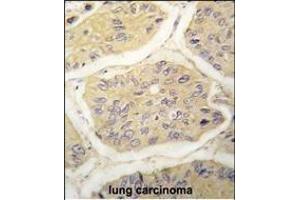 Formalin-fixed and paraffin-embedded human lung carcinoma tissue reacted with B2M antibody (N-term) (ABIN389258 and ABIN2839396) , which was peroxidase-conjugated to the secondary antibody, followed by DAB staining. (beta-2 Microglobulin Antikörper  (N-Term))