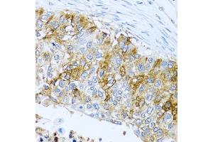 Immunohistochemistry of paraffin-embedded human lung cancer using IFIT3 antibody (ABIN1680389, ABIN3018293, ABIN3018295 and ABIN6220427) at dilution of 1:100 (40x lens). (IFIT3 Antikörper  (AA 128-331))