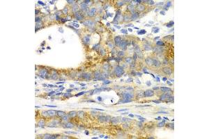 Immunohistochemistry of paraffin-embedded human gastric cancer using GORASP1 antibody (ABIN5973972) at dilution of 1/100 (40x lens).