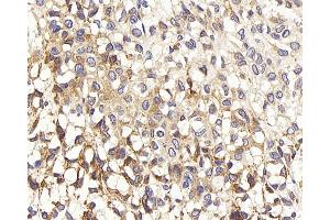 Immunohistochemistry analysis of paraffin-embedded human liver cancer using TEK Polyclonal Antibody at dilution of 1:200. (TEK Antikörper)