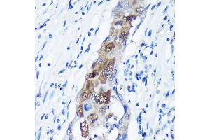 Immunohistochemistry of paraffin-embedded Human lung cancer using C Rabbit pAb (ABIN7266022) at dilution of 1:100 (40x lens). (CAMKK1 Antikörper  (AA 399-520))