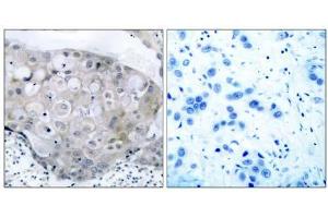 Immunohistochemical analysis of paraffin- embedded human breast carcinoma tissue using V (VEGFR2/CD309 Antikörper  (pTyr951))