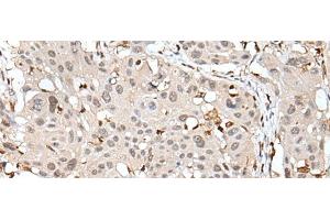 Immunohistochemistry of paraffin-embedded Human esophagus cancer tissue using ARHGDIB Polyclonal Antibody at dilution of 1:35(x200) (ARHGDIB Antikörper)