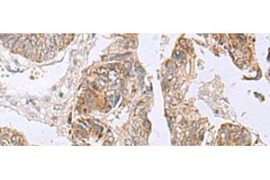 Immunohistochemistry of paraffin-embedded Human colorectal cancer tissue using RTKN2 Polyclonal Antibody at dilution of 1:75(x200) (RTKN2 Antikörper)