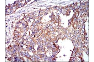 Immunohistochemical analysis of paraffin-embedded breast cancer tissues using G6PD mouse mAb with DAB staining. (Glucose-6-Phosphate Dehydrogenase Antikörper)