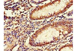 Immunohistochemistry of paraffin-embedded human colon cancer using ABIN7158054 at dilution of 1:100 (LRRIQ3 Antikörper  (AA 538-607))
