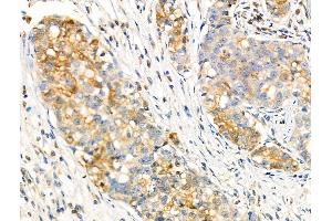 Phospho-FGFR2 (Tyr586/Tyr588) Antibody at 1/100 staining Human gastric cancer by IHC-P. (FGFR2 Antikörper  (pTyr586, pTyr588))