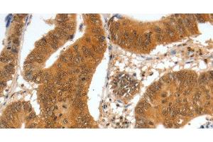 Immunohistochemistry of paraffin-embedded Human colon cancer tissue using SPDEF Polyclonal Antibody at dilution 1:60 (SPDEF/PSE Antikörper)
