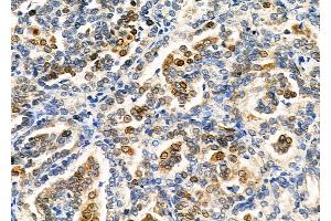 ABIN6265731 and ABIN6266699 at 1/100 staining Human kidney cancer by IHC-P. (TRIM24 Antikörper  (C-Term))