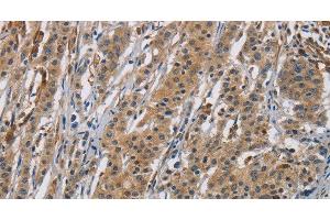 Immunohistochemistry of paraffin-embedded Human gastic cancer using RAGE Polyclonal Antibody at dilution of 1:70 (RAGE Antikörper)