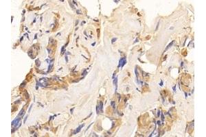 Detection of CK10 in Human Breast cancer Tissue using Polyclonal Antibody to Cytokeratin 10 (CK10) (Keratin 10 Antikörper  (AA 153-456))