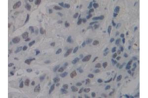 Detection of NCL in Human Mastadenoma Tissue using Polyclonal Antibody to Nucleolin (NCL) (Nucleolin Antikörper  (AA 388-569))