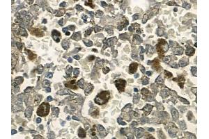 ABIN6257683 and ABIN6274587 at 1/100 staining human melanoma by IHC-P. (Apoptosis Inhibitor 5 Antikörper  (C-Term))