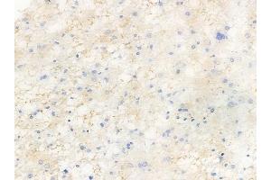 ABIN6256627 and ABIN6267491 at 1/100 staining human astrocytoma by IHC-P. (VEGFR2/CD309 Antikörper  (pTyr1214))