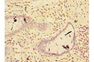 Immunohistochemistry of paraffin-embedded human colon cancer using ABIN7151160 at dilution of 1:100 (RNF181 Antikörper  (AA 2-153))