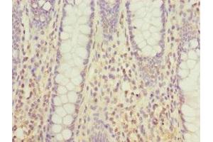 Immunohistochemistry of paraffin-embedded human colon cancer using ABIN7172381 at dilution of 1:100