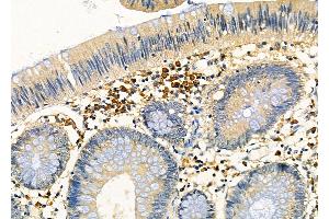 ABIN6266309 and ABIN6277454 at 1/100 staining Human colorectal cancer by IHC-P. (PPP2CB Antikörper  (C-Term))