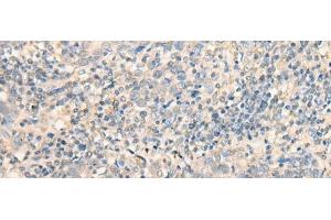 Immunohistochemistry of paraffin-embedded Human cervical cancer tissue using MR1 Polyclonal Antibody at dilution of 1:40(x200)