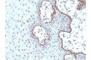 Formalin-fixed, paraffin-embedded human cervical carcinoma stained with c-Myc antibody (9E10. (c-MYC Antikörper)