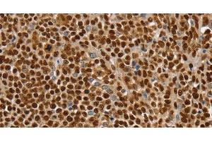 Immunohistochemistry of paraffin-embedded Human ovarian cancer using SSB Polyclonal Antibody at dilution of 1:30 (SSB Antikörper)