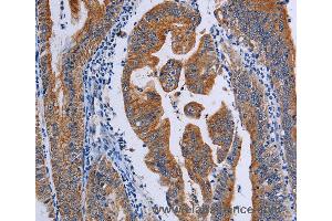 Immunohistochemistry of Human prostate cancer using ACP6 Polyclonal Antibody at dilution of 1:50 (ACP6 Antikörper)