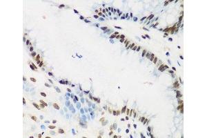 Immunohistochemistry of paraffin-embedded Human stomach cancer using KLF4 Polyclonal Antibody at dilution of 1:200 (40x lens). (KLF4 Antikörper)